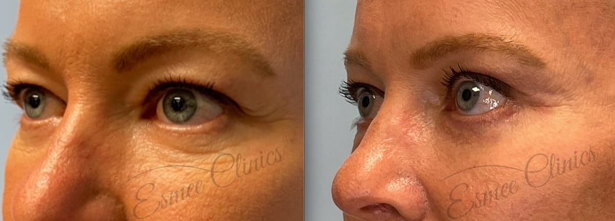 Before and After img